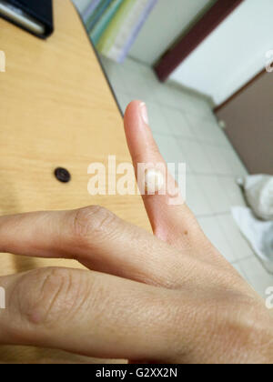 Close-up of a wart on the index finger of a female patient. Warts are harmless lumps on the skin caused by the human papilloma v Stock Photo