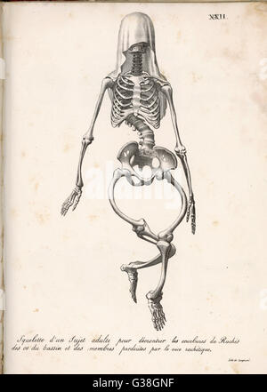 Skeleton of an adult patient  afflicted with rickets  (rachitis)        Date: 1827 Stock Photo