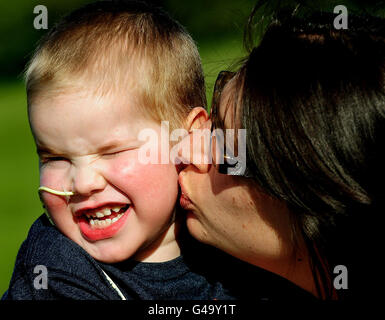 Smallest patient gets new lungs Stock Photo