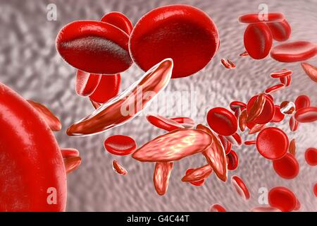 Sickle cell anaemia. Artwork showing normal red blood cells (round), and red blood cells affected by sickle cell anaemia (crescent shaped). This is a disease in which the red blood cells contain an abnormal form of haemoglobin (blood's oxygen-carrying pigment) that causes the blood cells to become sickle-shaped, rather than round. Sickle cells cannot move through small blood vessels as easily as normal cells and so can cause blockages (right). This prevents oxygen from reaching the tissues, causing severe pain and organ damage. Stock Photo
