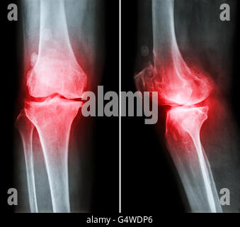 Anterior and posterior view of a femur Stock Photo: 103992464 - Alamy