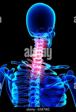 3D illustration, neck painful skeleton x-ray, medical concept. Stock Photo