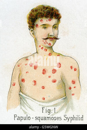 medicine, sexually transmitted diseases, syphilis, papulosquamous syphilis, from: Friedrich Eduard Bilz, New Naturopathic Treatment, Leipzig, Germany, 1902, Additional-Rights-Clearences-Not Available Stock Photo