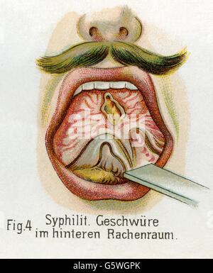 medicine, sexually transmitted diseases, syphilis, syphilitic blains in throat, from: Friedrich Eduard Bilz, New Naturopathic Treatment, Leipzig, Germany, 1902, Additional-Rights-Clearences-Not Available Stock Photo