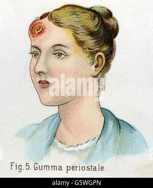 medicine, sexually transmitted diseases, syphilis, Gumma periostale, from: Friedrich Eduard Bilz, New Naturopathic Treatment, Leipzig, Germany, 1902, Additional-Rights-Clearences-Not Available Stock Photo