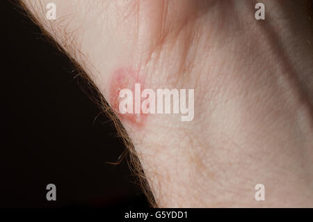 Ringworm on white man skin / Fungus Infection / Mycosis Stock Photo