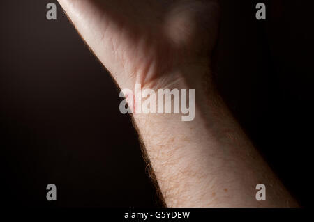 Ringworm on white man skin / Fungus Infection / Mycosis Stock Photo