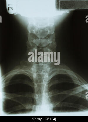 X Ray with Neck Chest and Head. Stock Photo