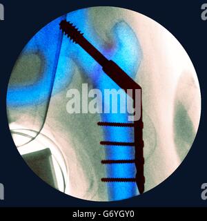 Pinned fractured hip. Coloured X-ray of a section through the hip of a 91-year-old female patient with a fracture affecting the head of the femur (thigh bone, vertical), showing plates and pins (black) being used to fix the broken bone in place during hea Stock Photo