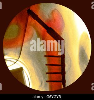 Pinned fractured hip. Coloured X-ray of a section through the hip of a 91-year-old female patient with a fracture affecting the head of the femur (thigh bone, vertical), showing plates and pins (black) being used to fix the broken bone in place during hea Stock Photo