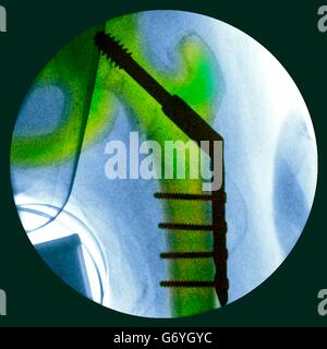 Pinned fractured hip. Coloured X-ray of a section through the hip of a 91-year-old female patient with a fracture affecting the head of the femur (thigh bone, vertical), showing plates and pins (black) being used to fix the broken bone in place during hea Stock Photo