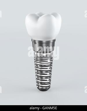 3D illustration of tooth implant on white background, dental concept. Stock Photo