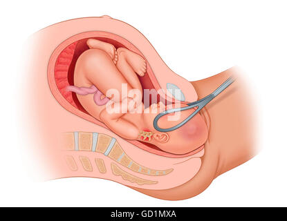 Cross Section Of The Mother's Anatomy Showing The Baby Op In Uteruo Being Delivered By Forceps, Turning Baby's Head From Rop To Op. Because The Bab... Stock Photo