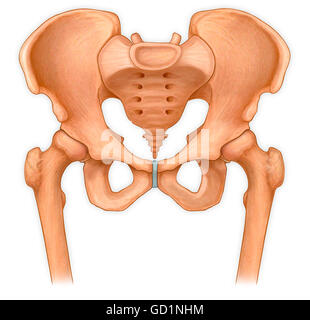 Anterior view of pelvis with hip bones showing arthritis and ...