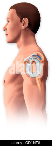 Lateral view of the shoulder joint showing a tear in the labrum and an inflamed bursa Stock Photo