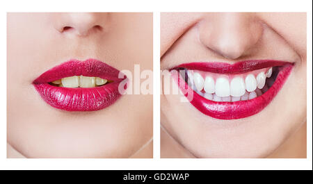 Whitening before and after Stock Photo