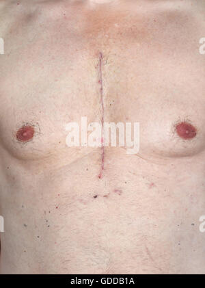 Scar from open heart surgery,where the sternum was cut in two,and the rib cage sprung. Below the scar holes show where the dra Stock Photo