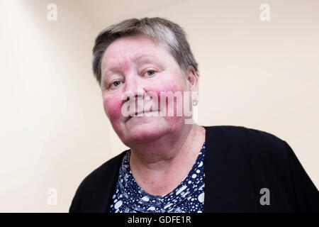Elderly woman with rosacea, facial skin disorder