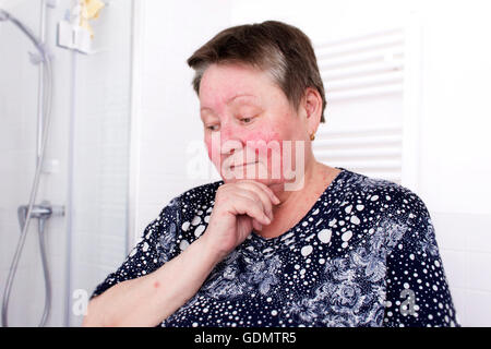 Elderly woman with rosacea, facial skin disorder
