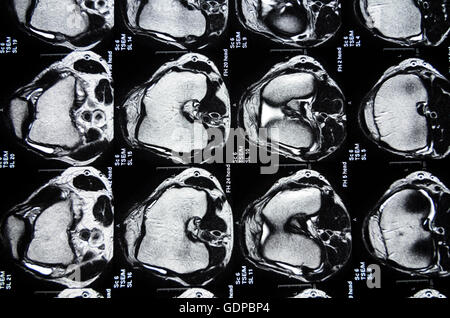 : Magnetic Resonance Imaging ( MRI ) : cross-sectional images of a knee, , , Stock Photo