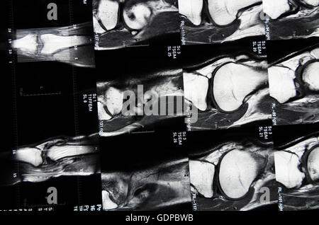: Magnetic Resonance Imaging ( MRI ) : cross-sectional images of a knee, , , Stock Photo
