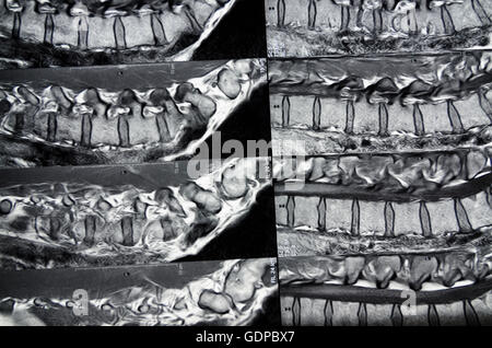 : Magnetic Resonance Imaging ( MRI ) : cross-sectional images of the lumbar spine, , , Stock Photo