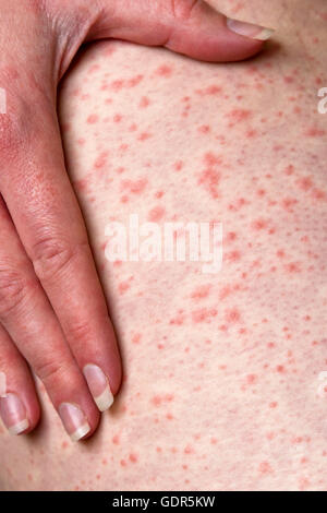 An urticarial rash caused by an allergic reaction to penicillin