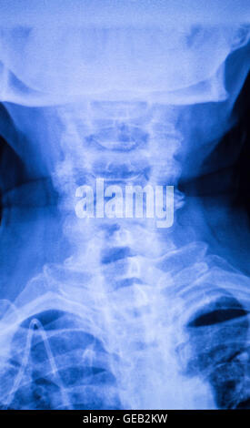 Neck and spine xray traumatology and orthopedics spinal vertebra test ...