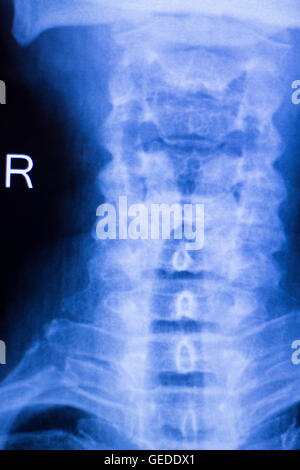 Neck and spine xray traumatology and orthopedics spinal vertebra test ...