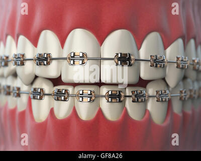 Teeth with braces or brackets in open human mouth. Dental care concept. 3d illustration Stock Photo