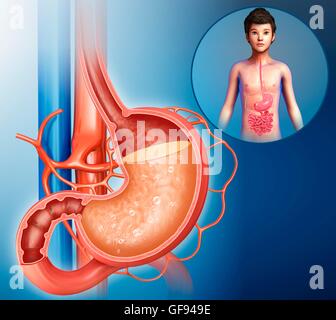 Illustration of stomach acidity in a child. Stock Photo