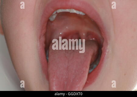 childs open mouth with view on tonsils Stock Photo