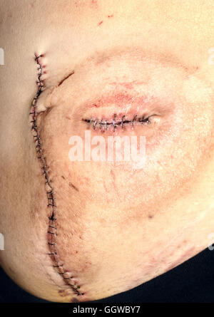 scar and stapled suctures from a closure enterostomy large and small intestine procedure Stock Photo