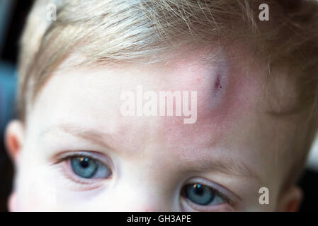 Young boy with head injury Stock Photo