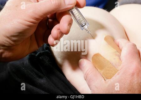 Closeup of man injecting Enoxaparin sodium, a low molecular weight heparin anticoagulant product into abdomen. Stock Photo