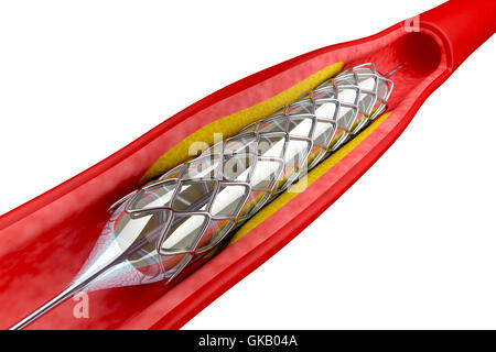 heart attack cardiology Stock Photo