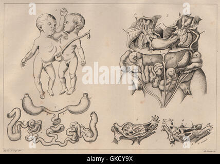 MUTATIONS: 'Monstruosités' Pl. VII. Conjoined twins, antique print 1834 Stock Photo