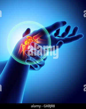 Wrist painful - skeleton x-ray, 3D Illustration medical concept. Stock Photo