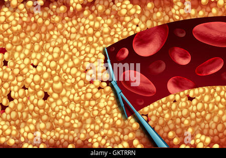 Removing cholesterol and cleaning arteries medical concept as a wiper removing plaque buildup in a clogged artery as a symbol of atherosclerosis disease hospital treatment by opening clogged veins as a 3D illustration. Stock Photo