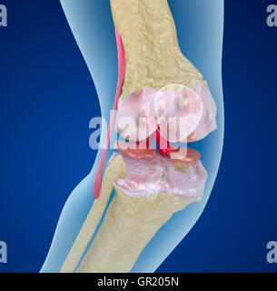 Osteoporosis of the knee joint,  Medically accurate 3D illustration Stock Photo