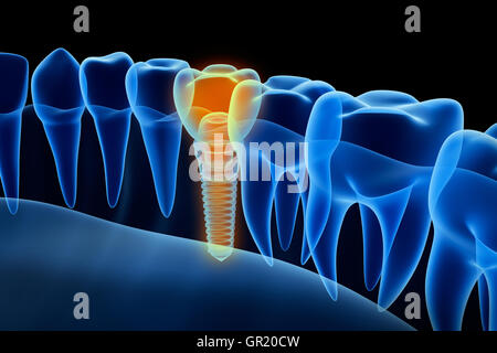 X-ray view of denture with implant.  Xray view. Medically accurate 3D illustration Stock Photo
