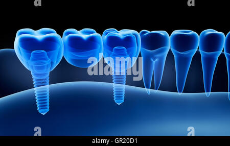 X-ray view of denture with implant.  Xray view. Medically accurate 3D illustration Stock Photo