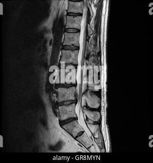 Mri Of A Lumbar-Disk Herniation Stock Photo