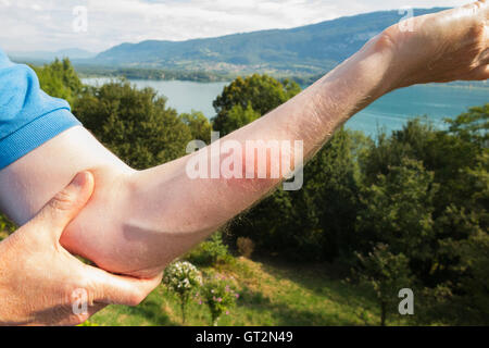 The raised arm of a British tourist swimmer with inflammation caused by the burrowing of a 'Duck flea' ('puces de canard' in French). Lac du Bourget, where the swimmer swam, is visible in the distance. Stock Photo