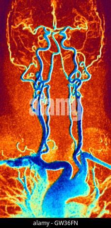 Chest, neck and head arteries. Coloured magnetic resonance angiography (MRA) scan of a normal carotid system of a 55 year old man. Bottom centre is the aortic arch, which curves over the heart. The arteries that branch off from these are: the brachiocepha Stock Photo