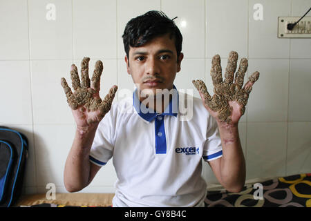 Dhaka, Bangladesh. 18th Sep, 2016. Abul Bajandar, 26, sits on a hospital bad in Dhaka, Bangladesh, September 18, 2016. Doctors carried out several operations to remove extremely rare epidermodysplasia verruciformis warts from his hands and legs. Abul, who was admitted to DMCH on January 30, has been suffering from an extremely rare genetic skin disease epidermodysplasia verruciformis, which is also referred to as 'Tree Man Disease.'' The disease is caused by a defect in the immune system. It causes abnormal susceptibility to human papilloma viruses (HPVs), which eventually leads to t Stock Photo