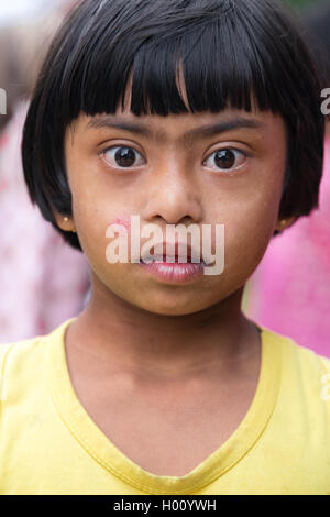 ELLA, SRI LANKA - MARCH 2, 2014: Portrait of Sri Lankan girl with Down Syndrome. 24.000 cases of Down Syndrome have been registe Stock Photo