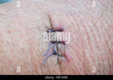 operation scar, three stitches Stock Photo