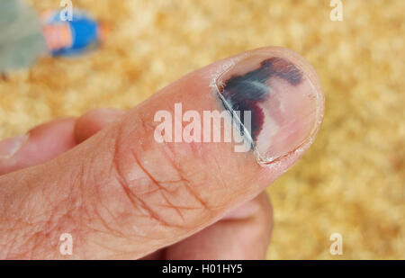 haematoma under thumbnail Stock Photo