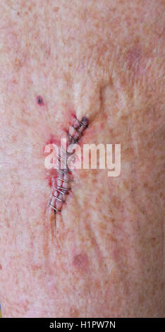 A dozen stainless steel medical staples were used in skin cancer surgery to close the wound after removing a squamous cell carcinoma on the leg of an elderly Caucasian man. Chronic sun exposure is the leading cause of this type of skin cancer, especially in people with fair skin, light hair and blue, green or gray eyes. Using surgical staples to close a wound is faster than suturing it by hand with needle and thread. Stock Photo